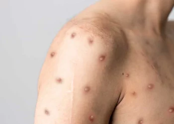 La OMS levanta la emergencia internacional por la viruela del mono tras 10 meses de alerta