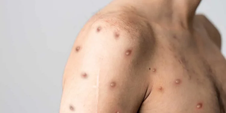 La OMS levanta la emergencia internacional por la viruela del mono tras 10 meses de alerta