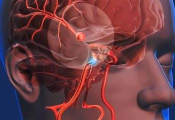 El ACV, primera causa de discapacidad en el adulto en República Dominicana