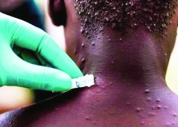 El país confirma seis casos de viruela símica y descarta 19 sospechosos en lo que va de año