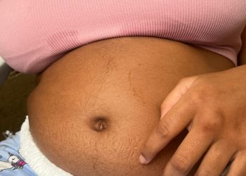 Madre desconocía la cesárea hecha a niña con parálisis cerebral