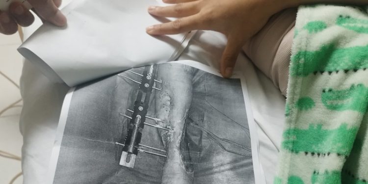 Jennifer Tavera, paciente del Jet Set, denuncia ya no tiene cobertura de Senasa para tratamiento