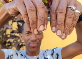 Joven pide ayuda para tratar sudoración inusual de las manos