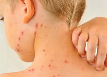 Los casos de sarampión superan los 4,500