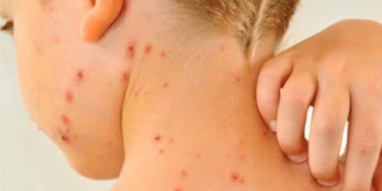 Los casos de sarampión superan los 4,500