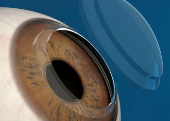 Con 370 trasplantes de córneas en un año, activarán bancos de donación en dos hospitales