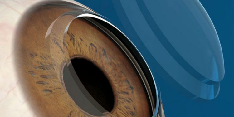 Con 370 trasplantes de córneas en un año, activarán bancos de donación en dos hospitales