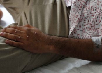 Sociedad de Infectología descarta transmisión comunitaria de viruela símica