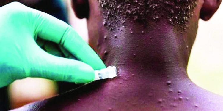 El país confirma seis casos de viruela símica y descarta 19 sospechosos en lo que va de año