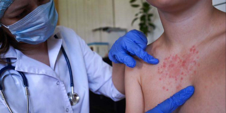 Sociedad Infectología alerta a RD sobre riesgo de sarampión