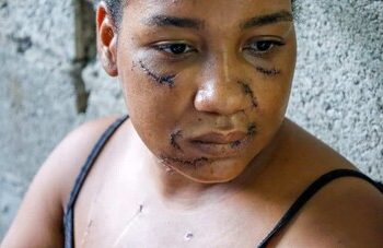 Sobrevivió a 26 estocadas y ahora lucha por sanar las heridas físicas y emocionales