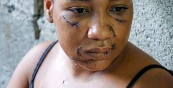 Sobrevivió a 26 estocadas y ahora lucha por sanar las heridas físicas y emocionales